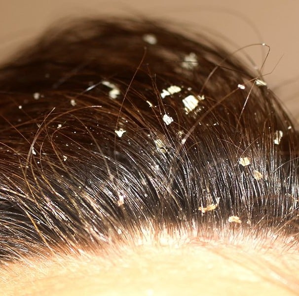 5 jeitos práticos de cuidar da caspa